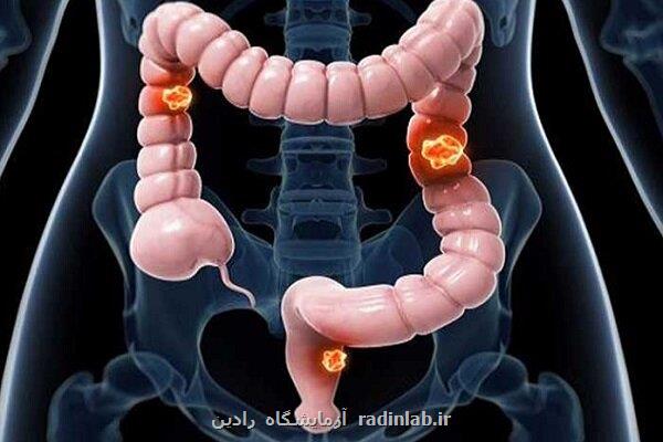 افزایش نرخ سرطان روده بزرگ در بین جوانان در سرتاسر جهان